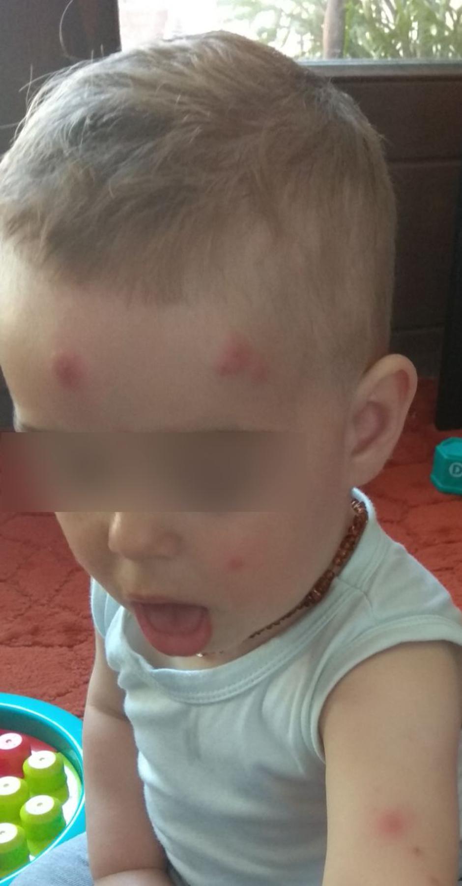 Djeca izbodena komarcima