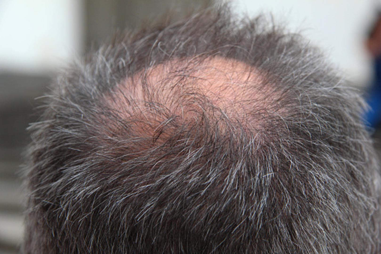 Imate nedijagnosticiranu autoimunu bolest – Alopecija areata je iznenadan gubitak kose ili dlaka. Riječ je o autoimunoj bolesti u kojoj vlastiti imunološki sustav iz dosad nepoznatog razloga napada folikule dlaka u koži i dolazi do opadanja kose.