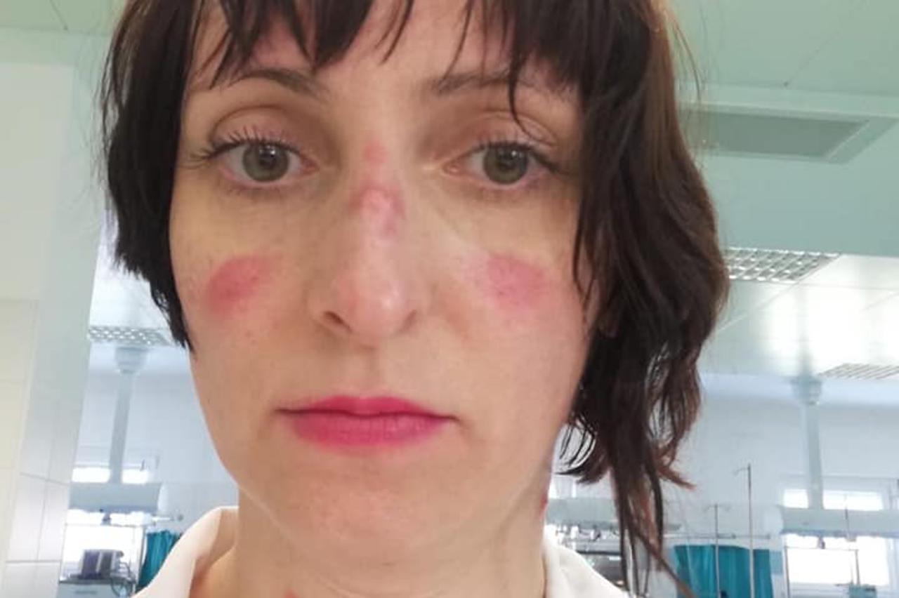 Anesteziologinja: "Ovo je moje lice nakon četiri i pol sata nošenja maske"