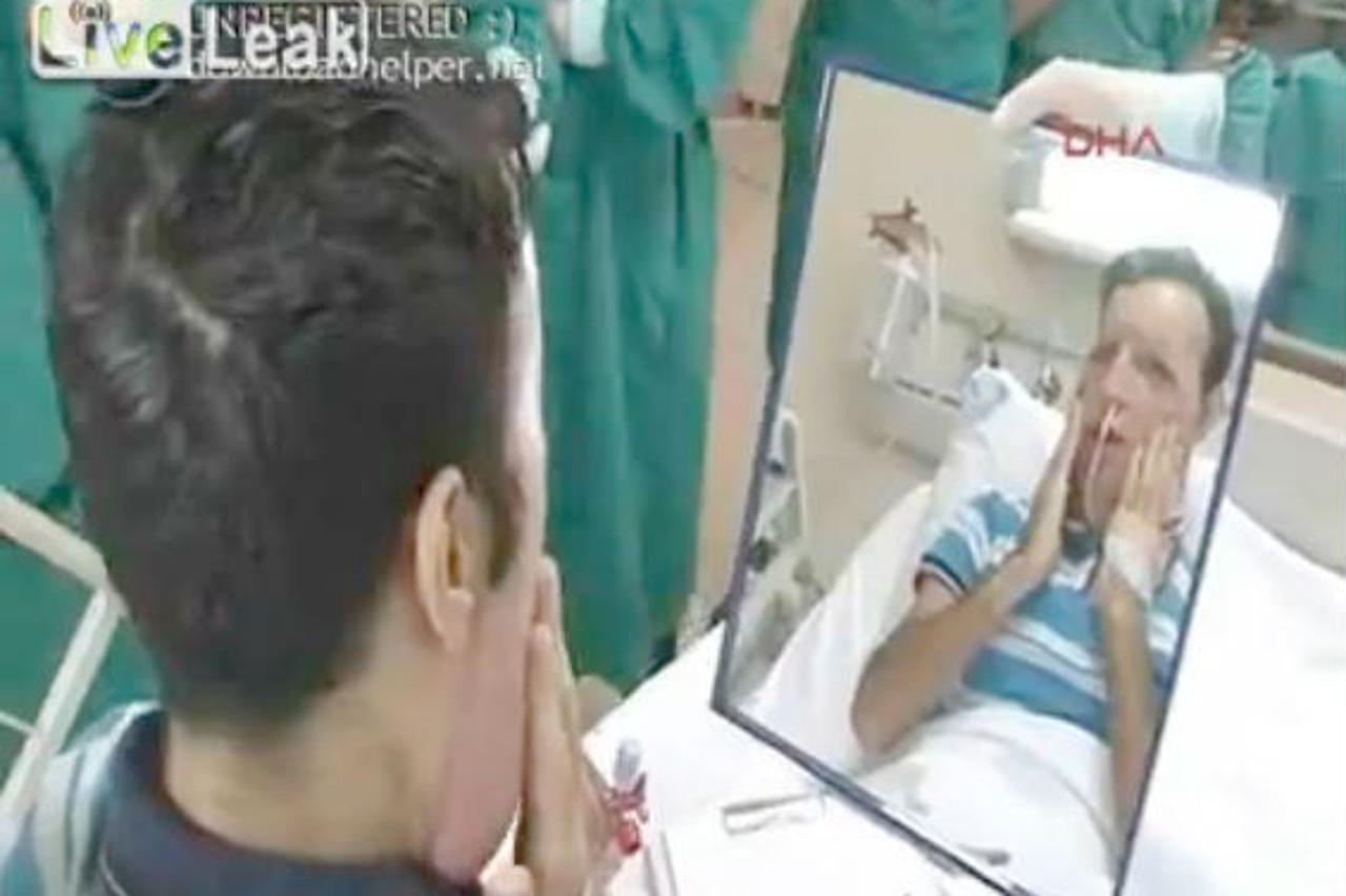 Prva reakcija pacijenta s transplantiranim licem nakon pogleda u ogledalo