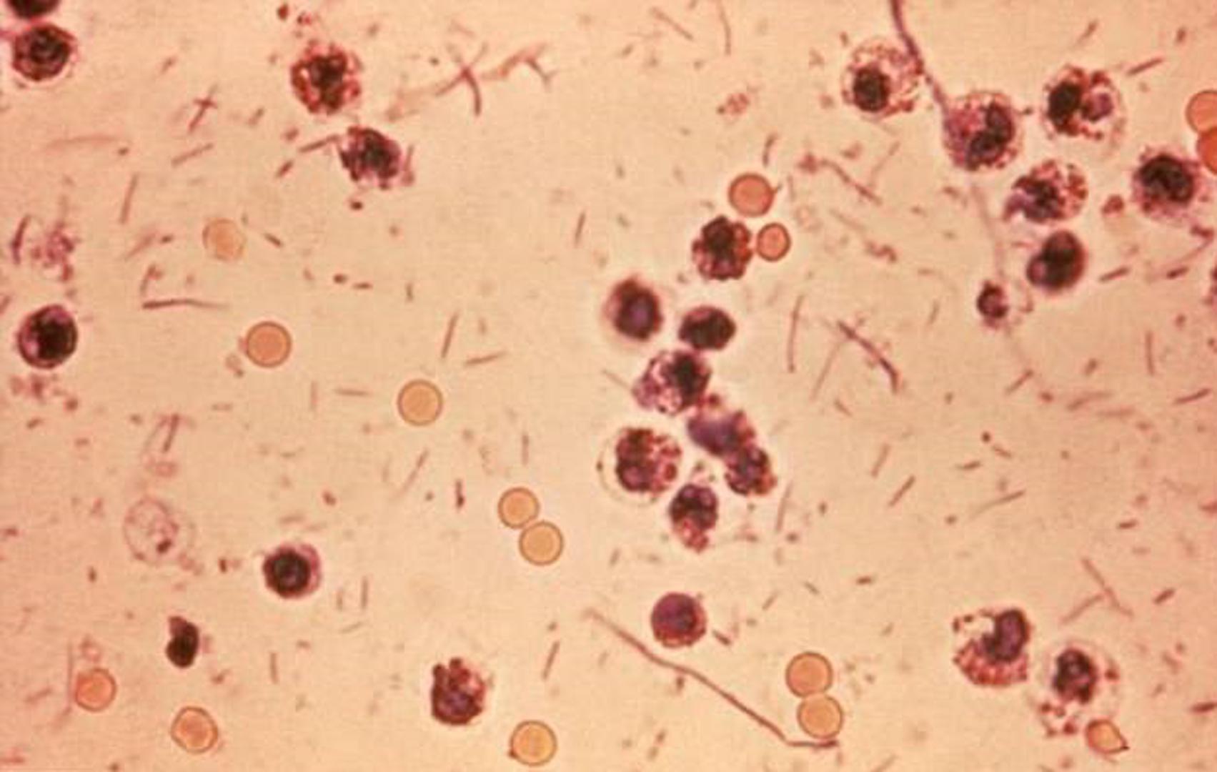 Šigela – Bakterija slična E. coli koja prouzroči od 74 tisuće do 600.000 smrti diljem svijeta svake godine. Manifestira se proljevima, a u stolici može biti krvi.