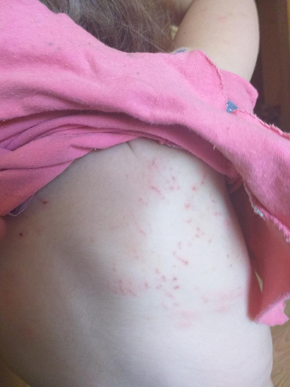 Djeca izbodena komarcima