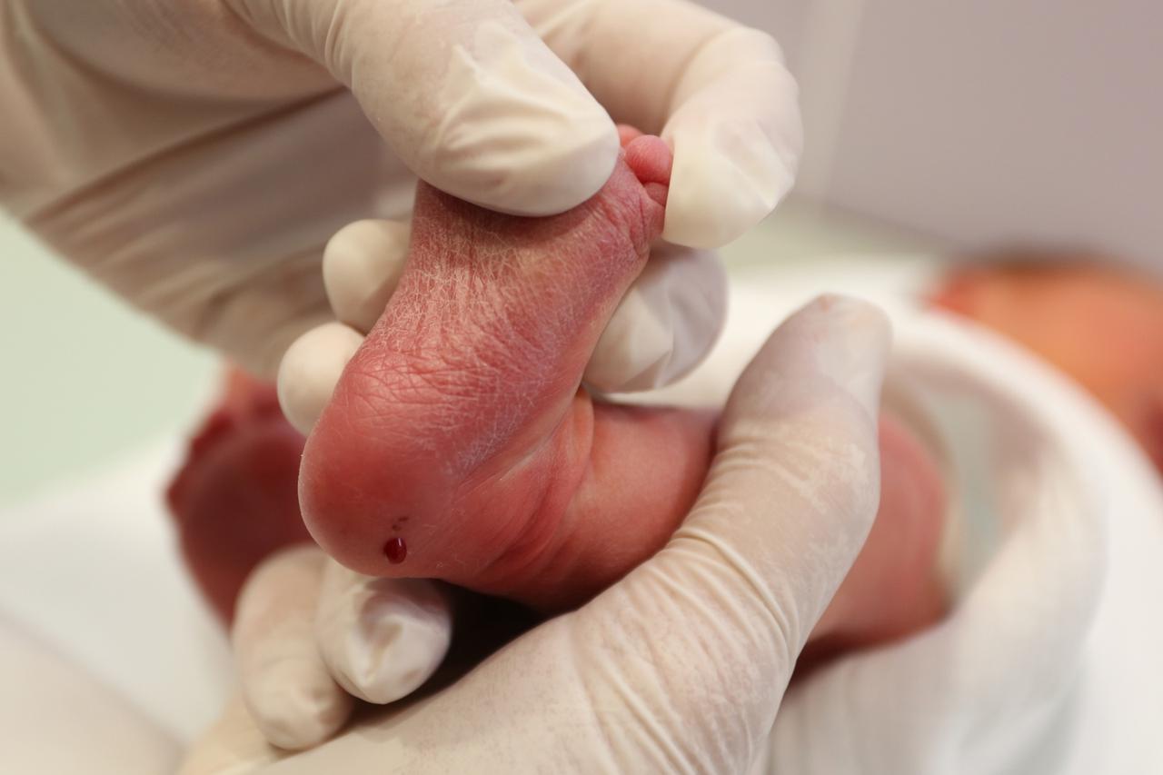 Vađenje krvi novorođenčetu iz pete