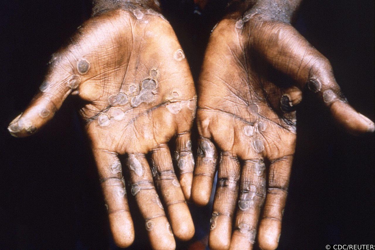 The palms of a monkeypox case patient from Lodja