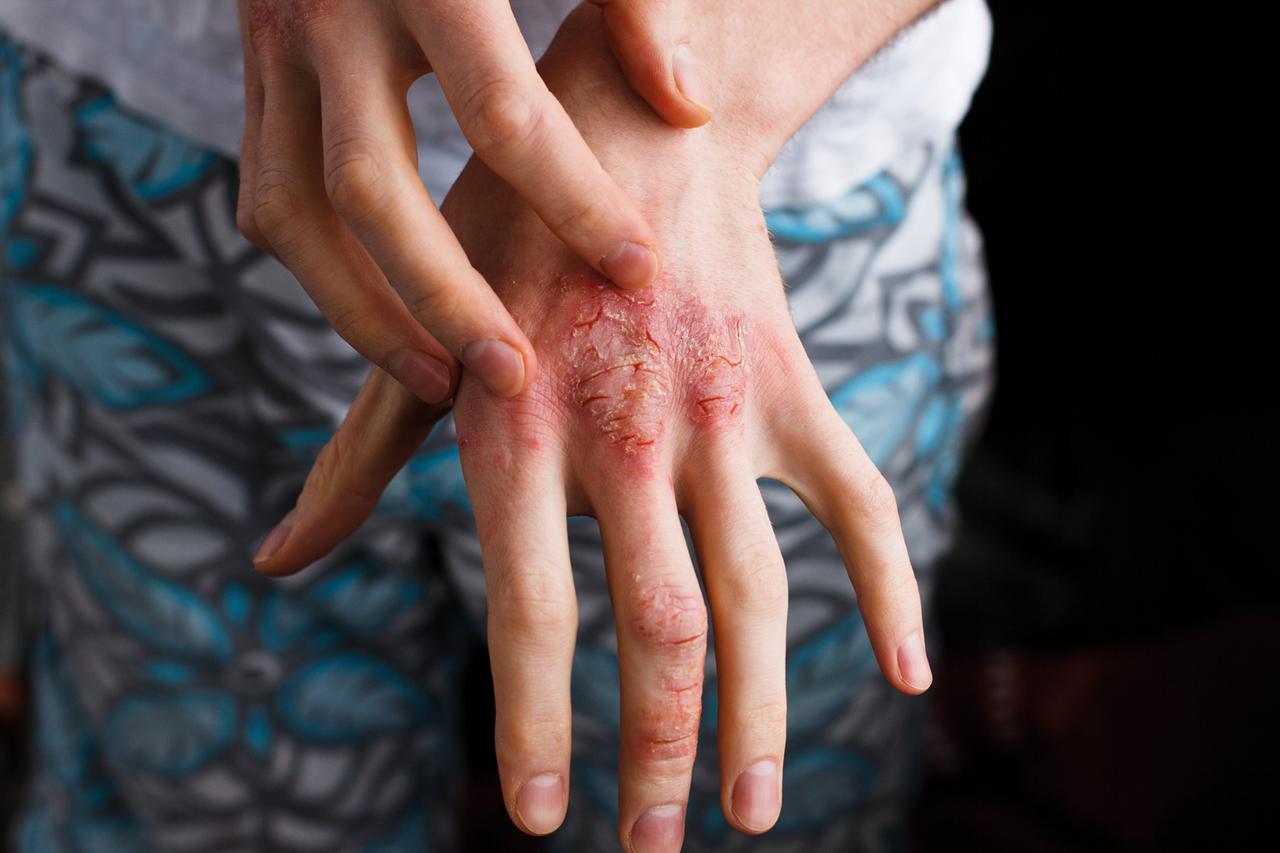 Dupilumab, prva ciljana biološka terapija za liječenje atopijskog dermatitisa